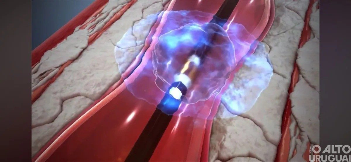 Cirurgia vascular para prevenir AVC é realizada pela primeira vez no Brasil